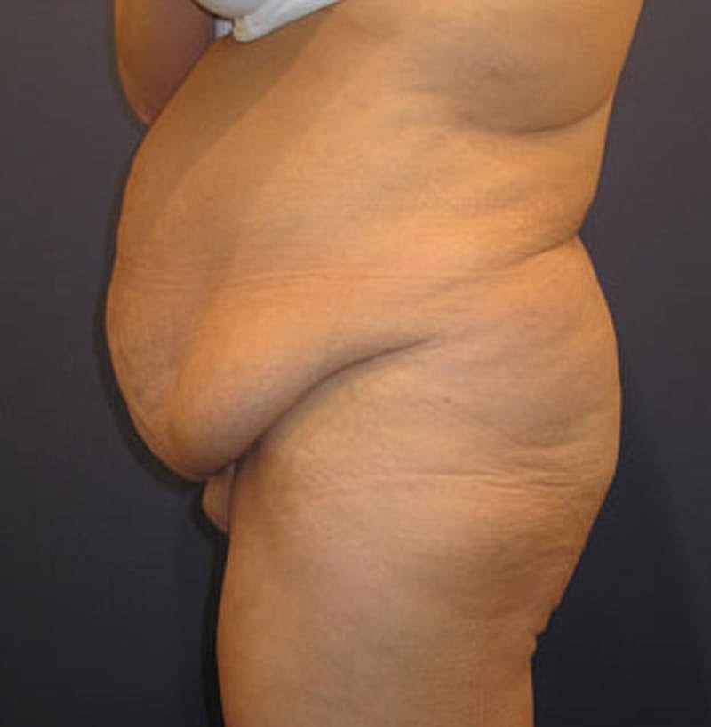 Tummy Tuck Before & After