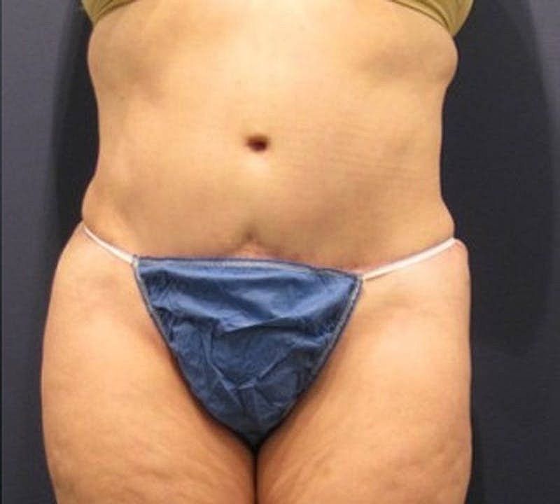 Tummy Tuck Before & After
