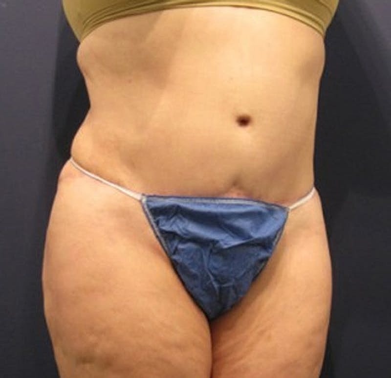 Tummy Tuck Before & After