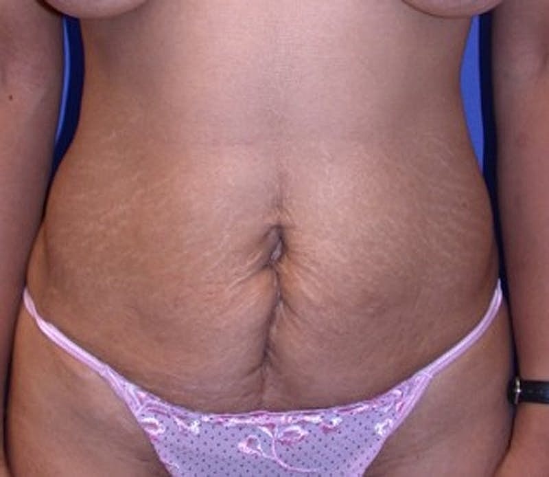 Tummy Tuck Before & After