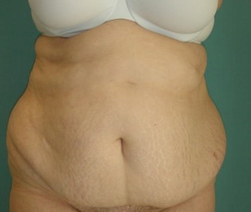 Tummy Tuck Before & After