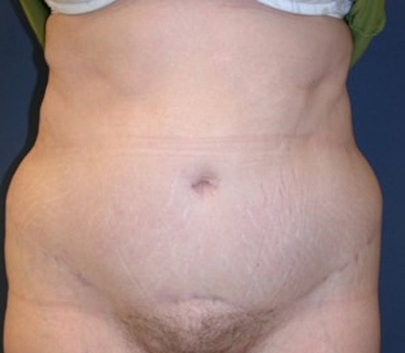 Tummy Tuck Before & After