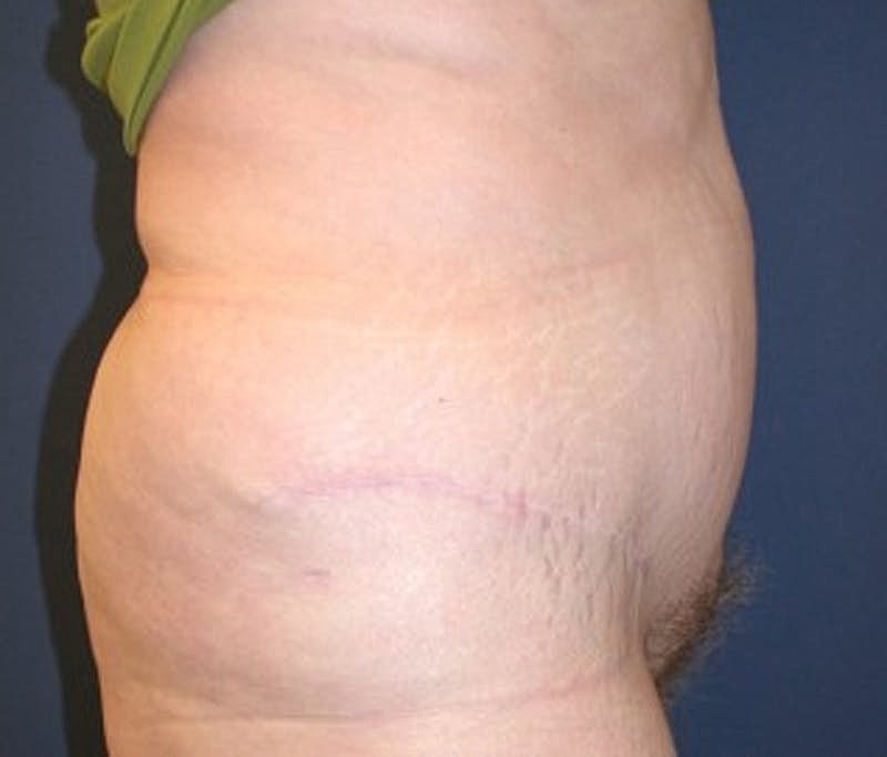 Tummy Tuck Before & After