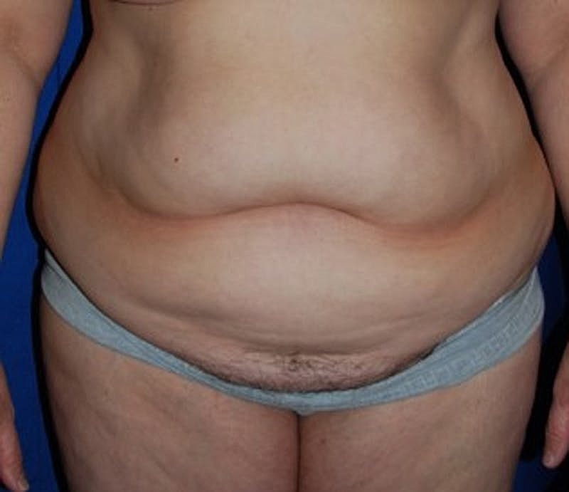 Tummy Tuck Before & After
