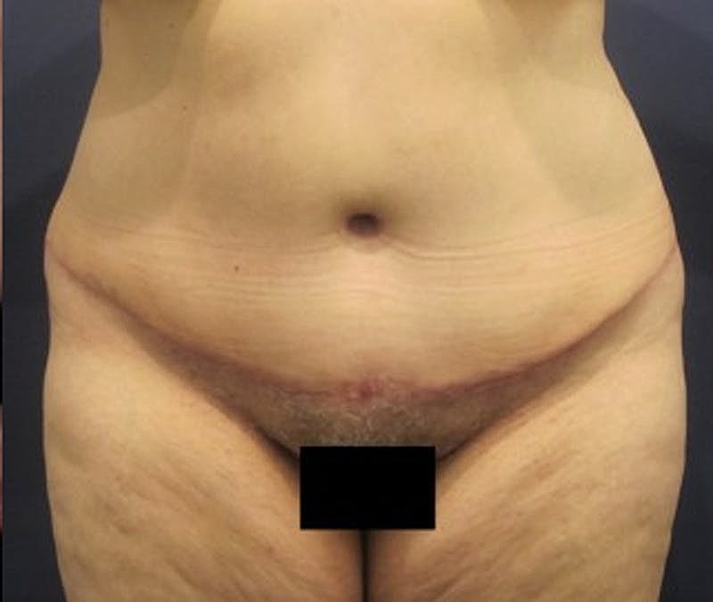 Tummy Tuck Before & After