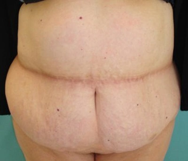 Tummy Tuck Before & After