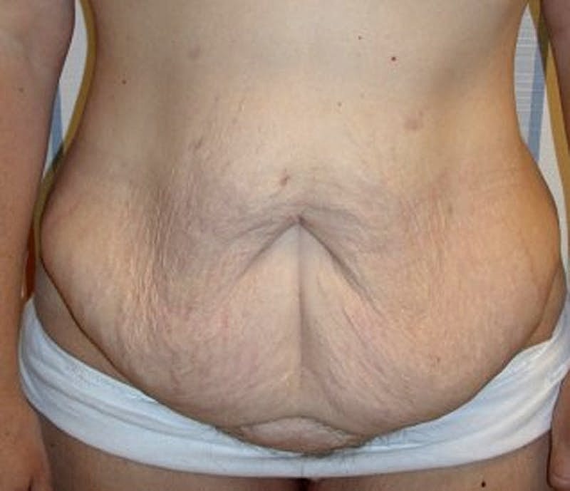 Tummy Tuck Before & After