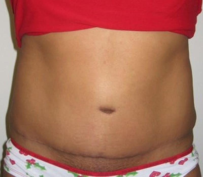 Tummy Tuck Before & After