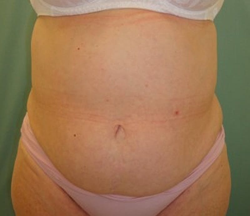 Tummy Tuck Before & After