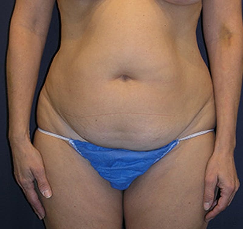 Tummy Tuck Before & After