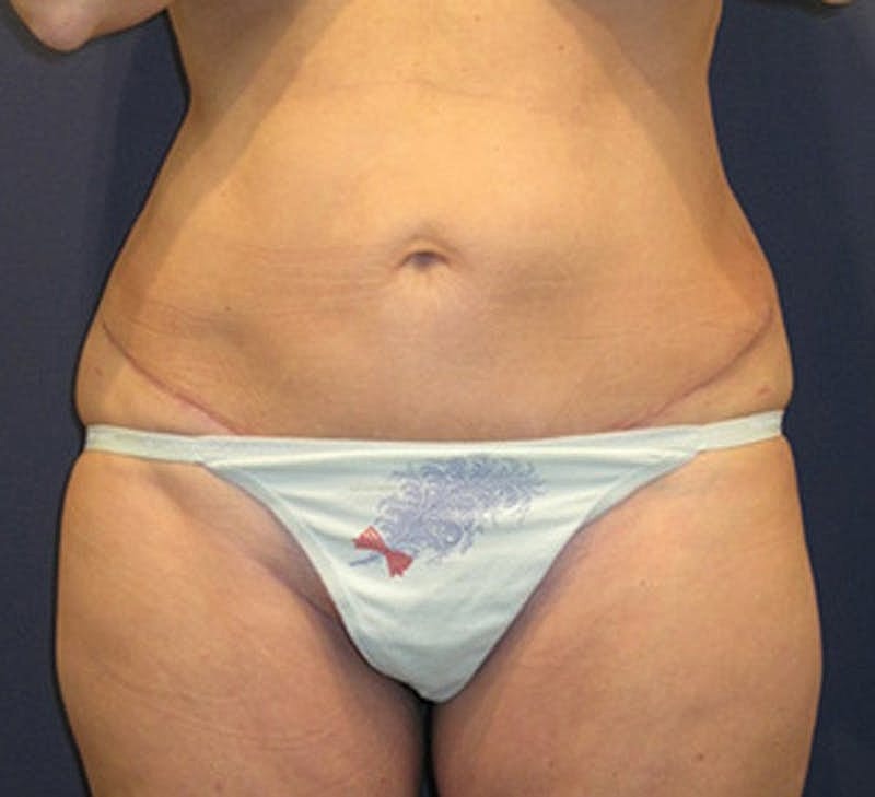 Tummy Tuck Before & After