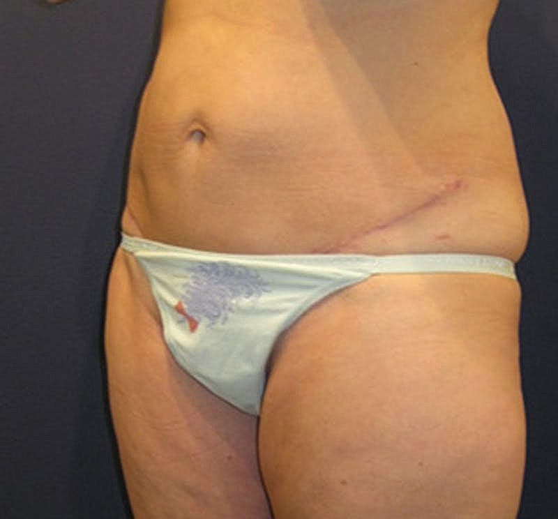 Tummy Tuck Before & After