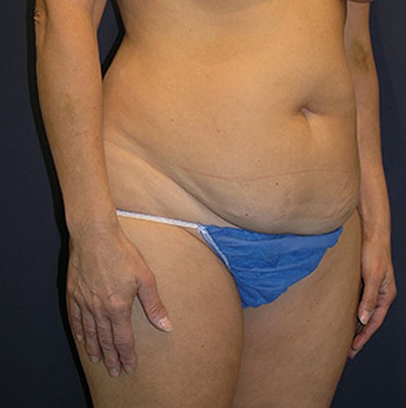 Tummy Tuck Before & After