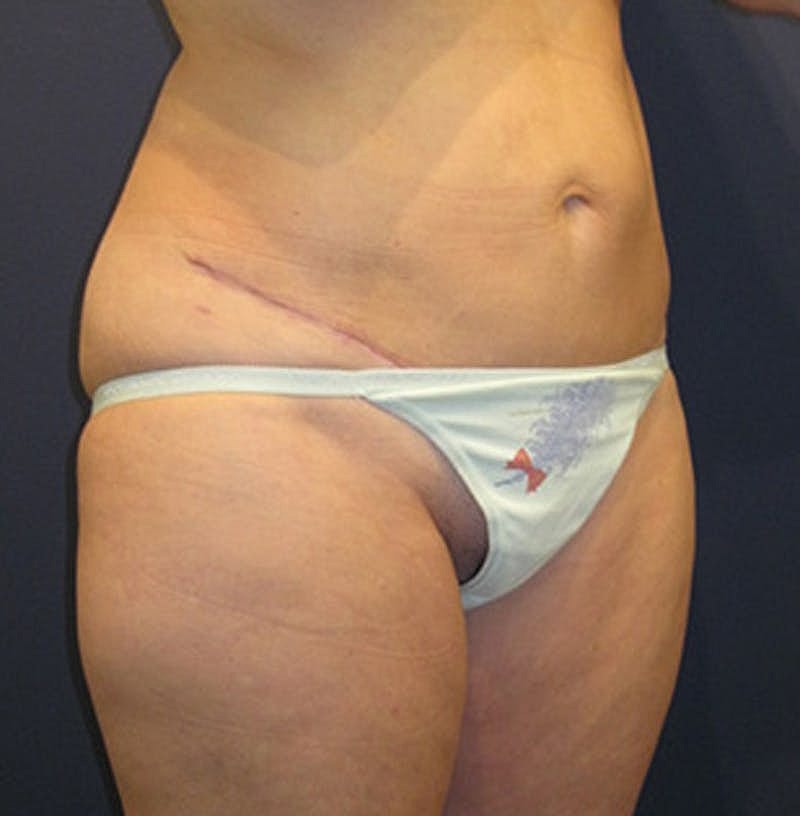 Tummy Tuck Before & After