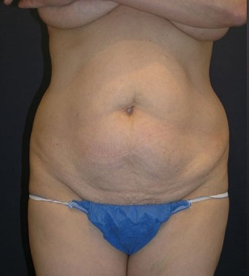 Tummy Tuck Before & After