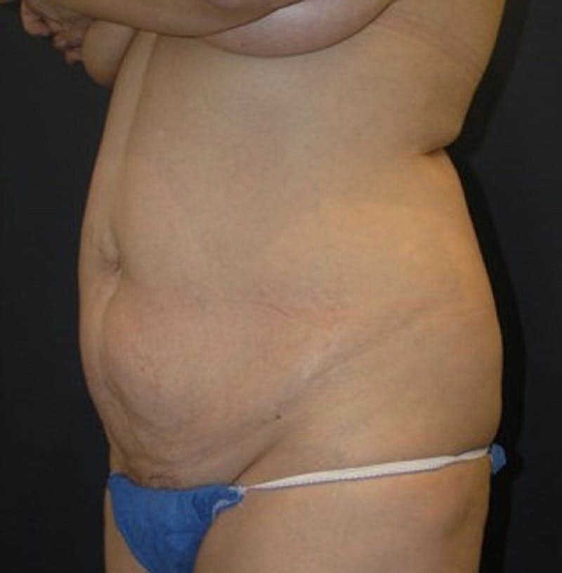 Tummy Tuck Before & After