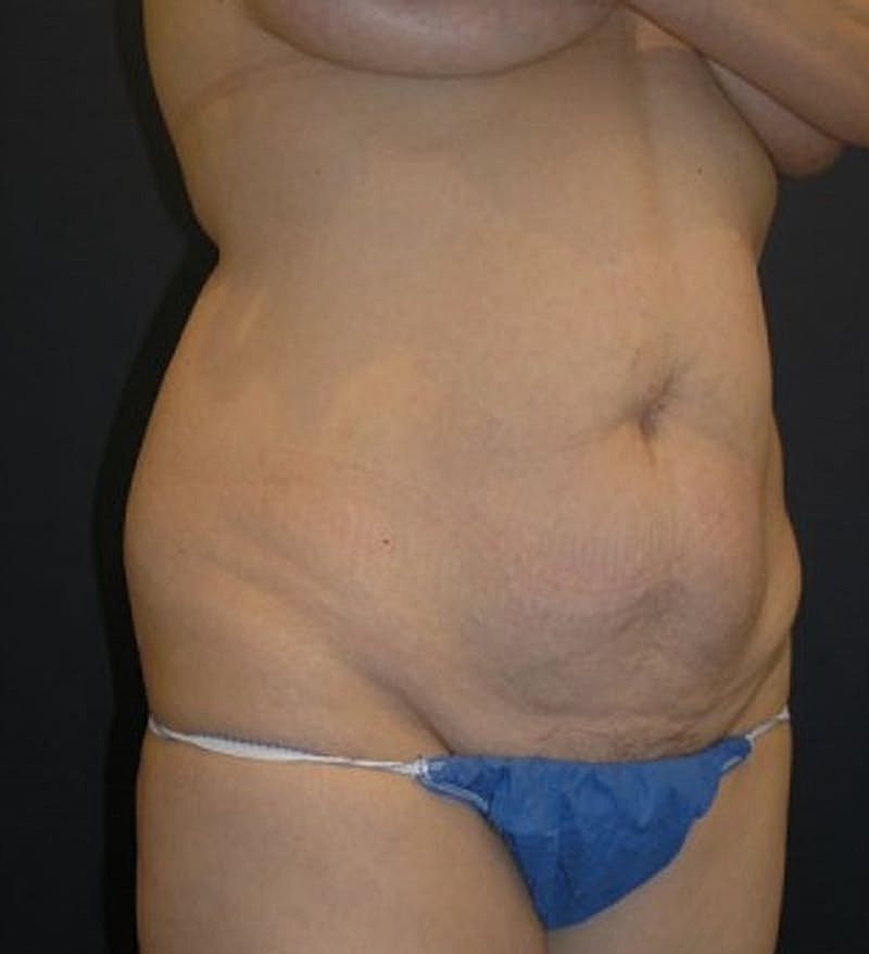 Tummy Tuck Before & After