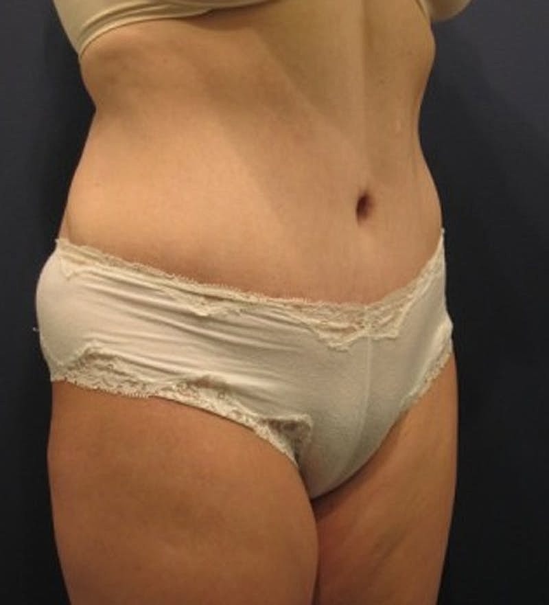 Tummy Tuck Before & After