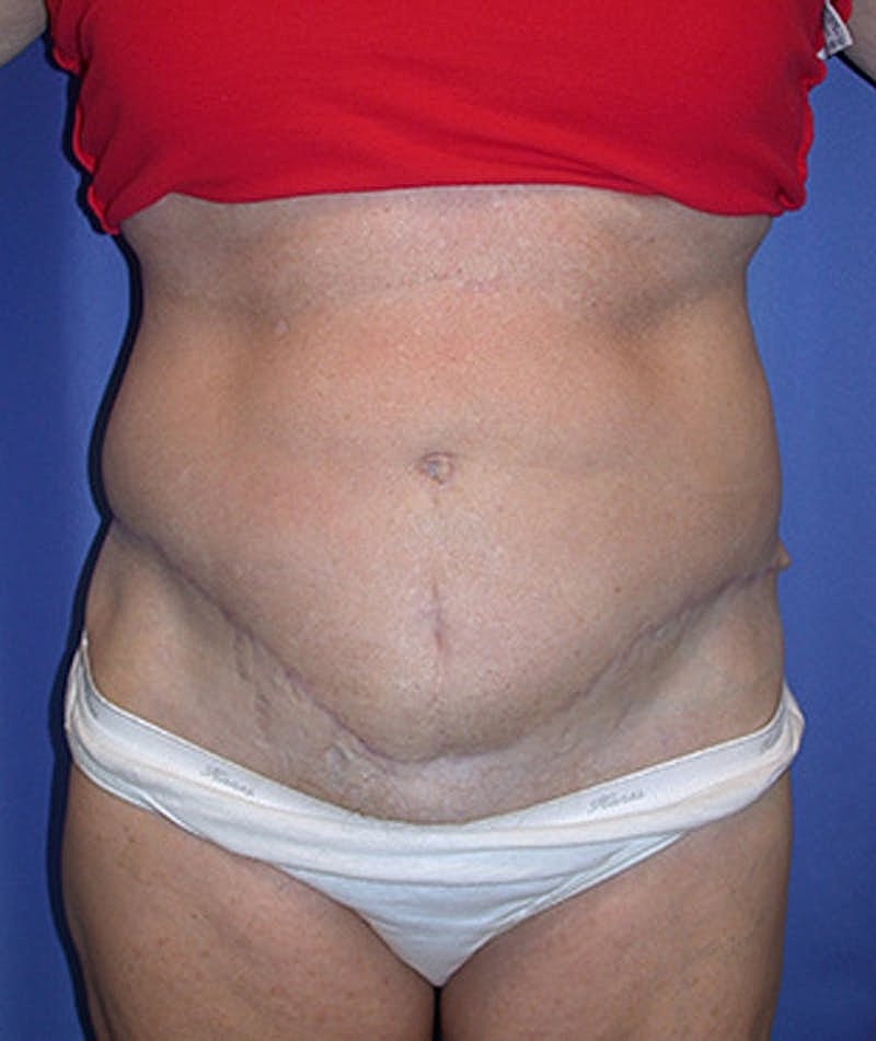 Tummy Tuck Before & After