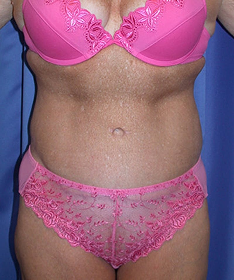 Tummy Tuck Before & After