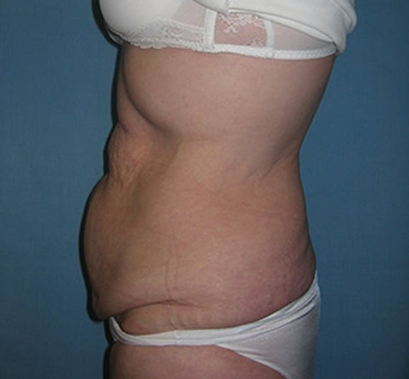 Tummy Tuck Before & After
