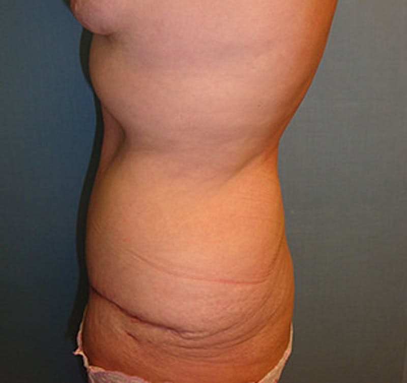 Tummy Tuck Before & After