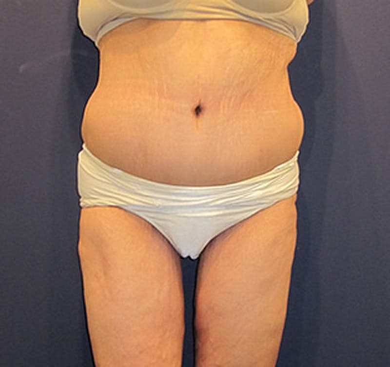 Tummy Tuck Before & After