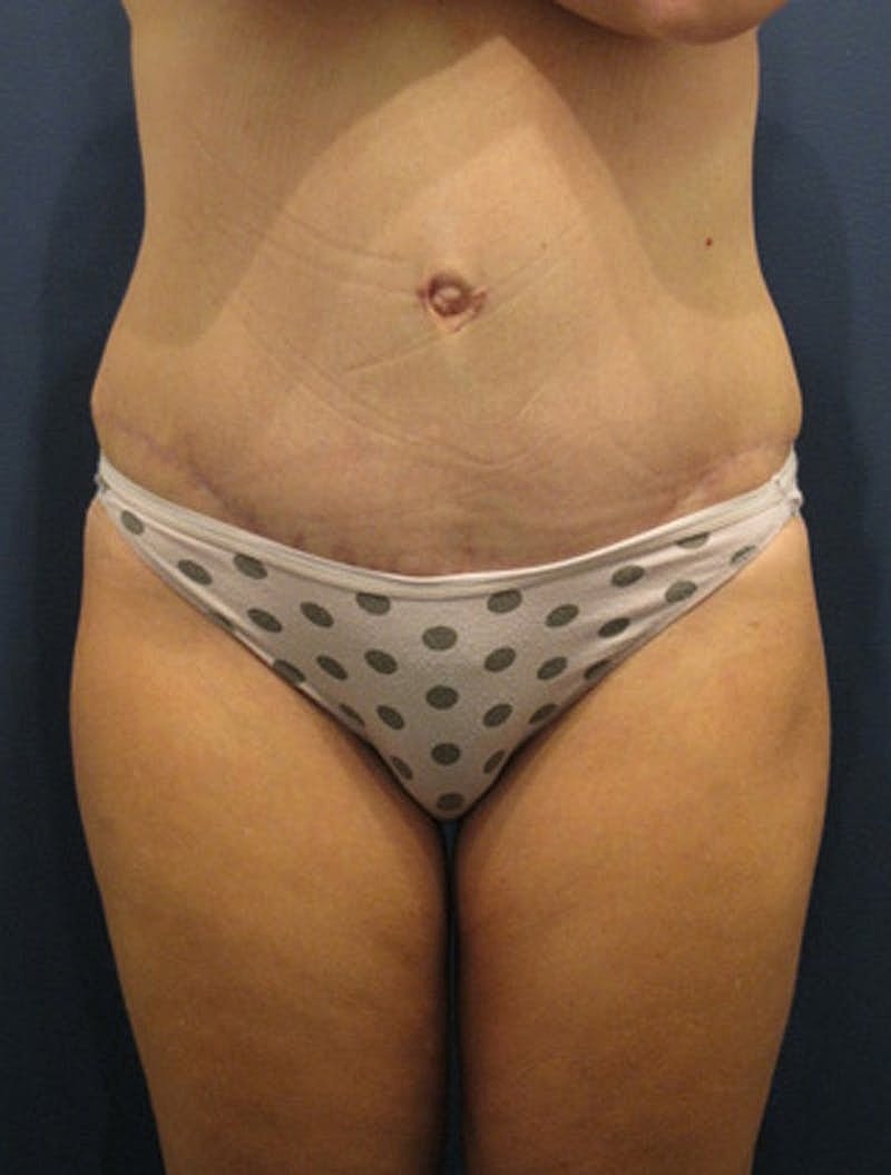 Tummy Tuck Before & After