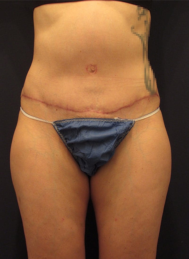 Tummy Tuck Before & After