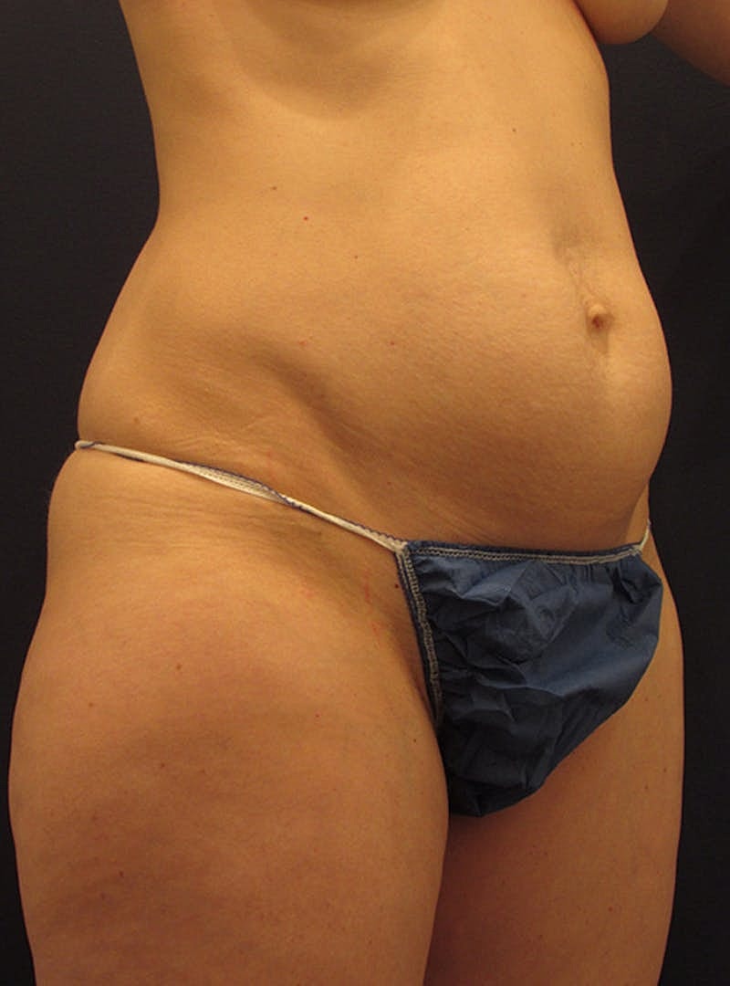 Tummy Tuck Before & After