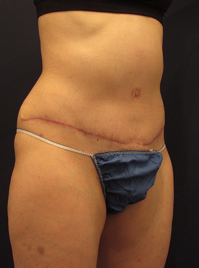 Tummy Tuck Before & After