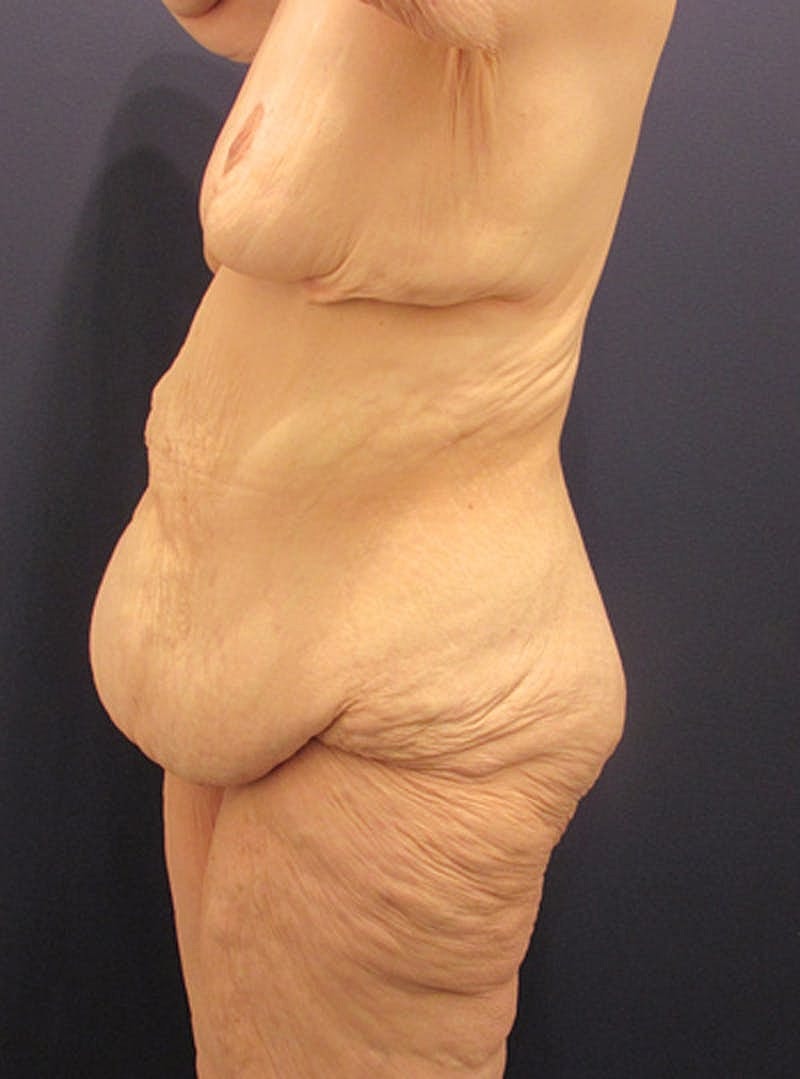 Tummy Tuck Before & After