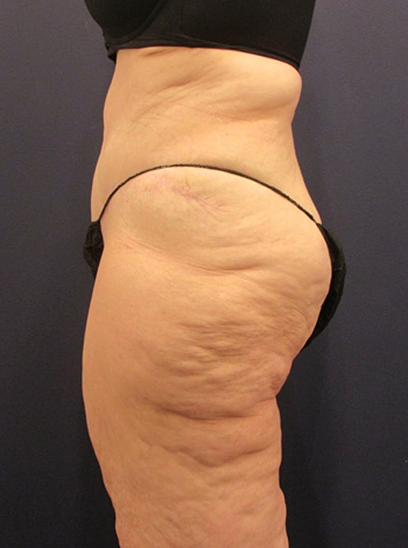 Tummy Tuck Before & After