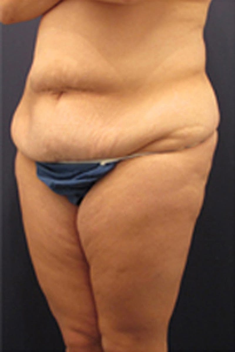 Tummy Tuck Before & After