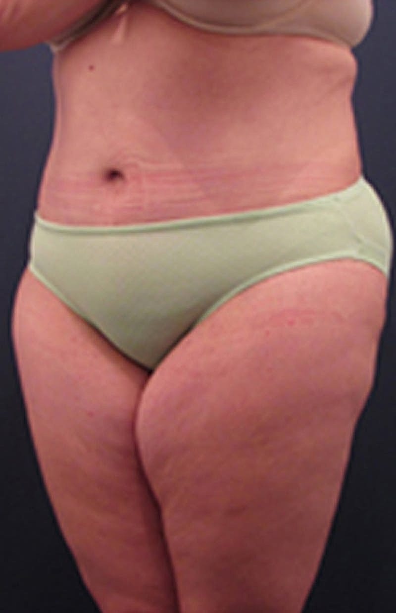 Tummy Tuck Before & After