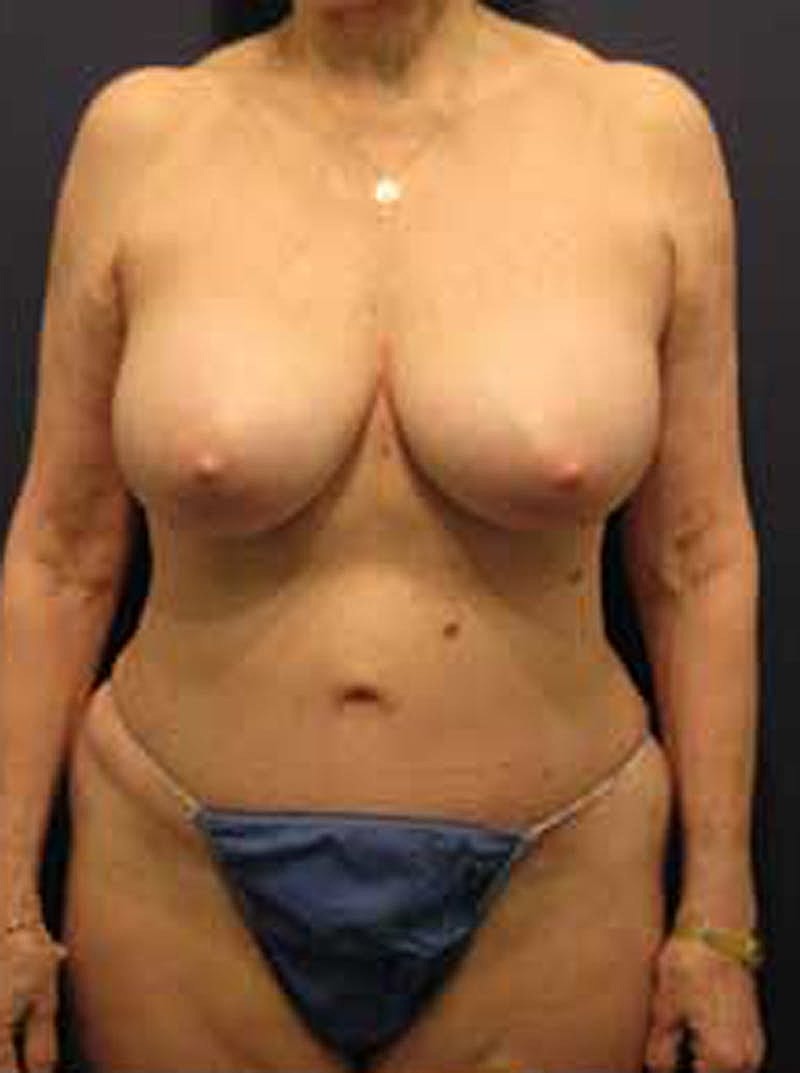 Tummy Tuck Before & After