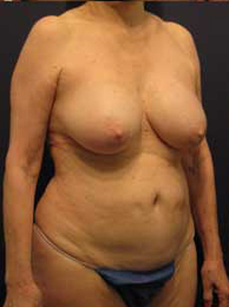 Tummy Tuck Before & After
