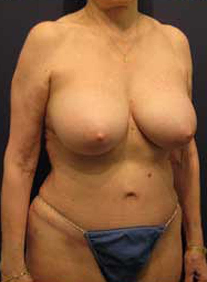 Tummy Tuck Before & After