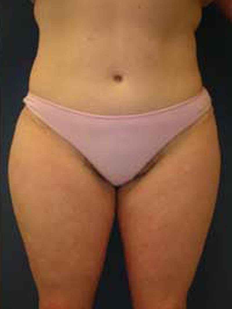 Tummy Tuck Before & After