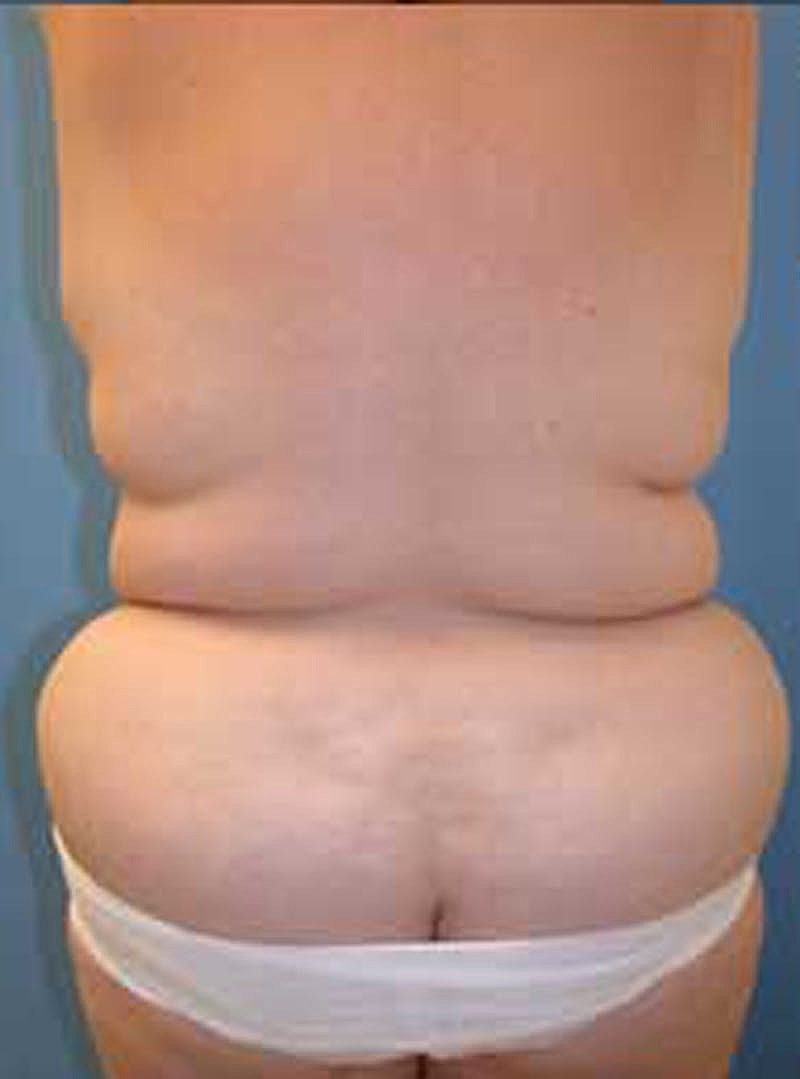 Tummy Tuck Before & After