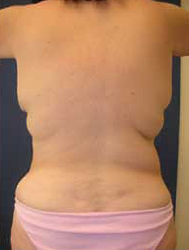 Tummy Tuck Before & After