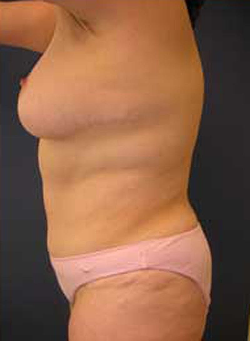 Tummy Tuck Before & After
