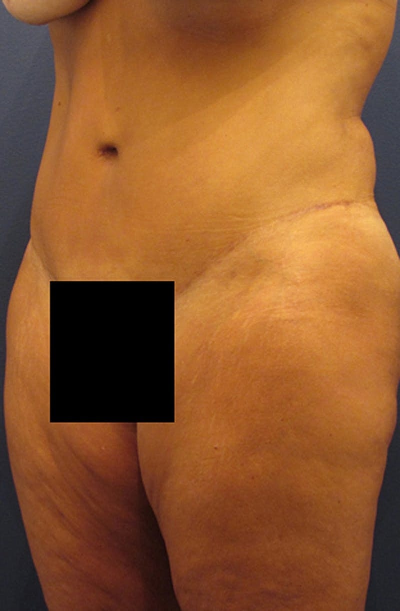 Tummy Tuck Before & After