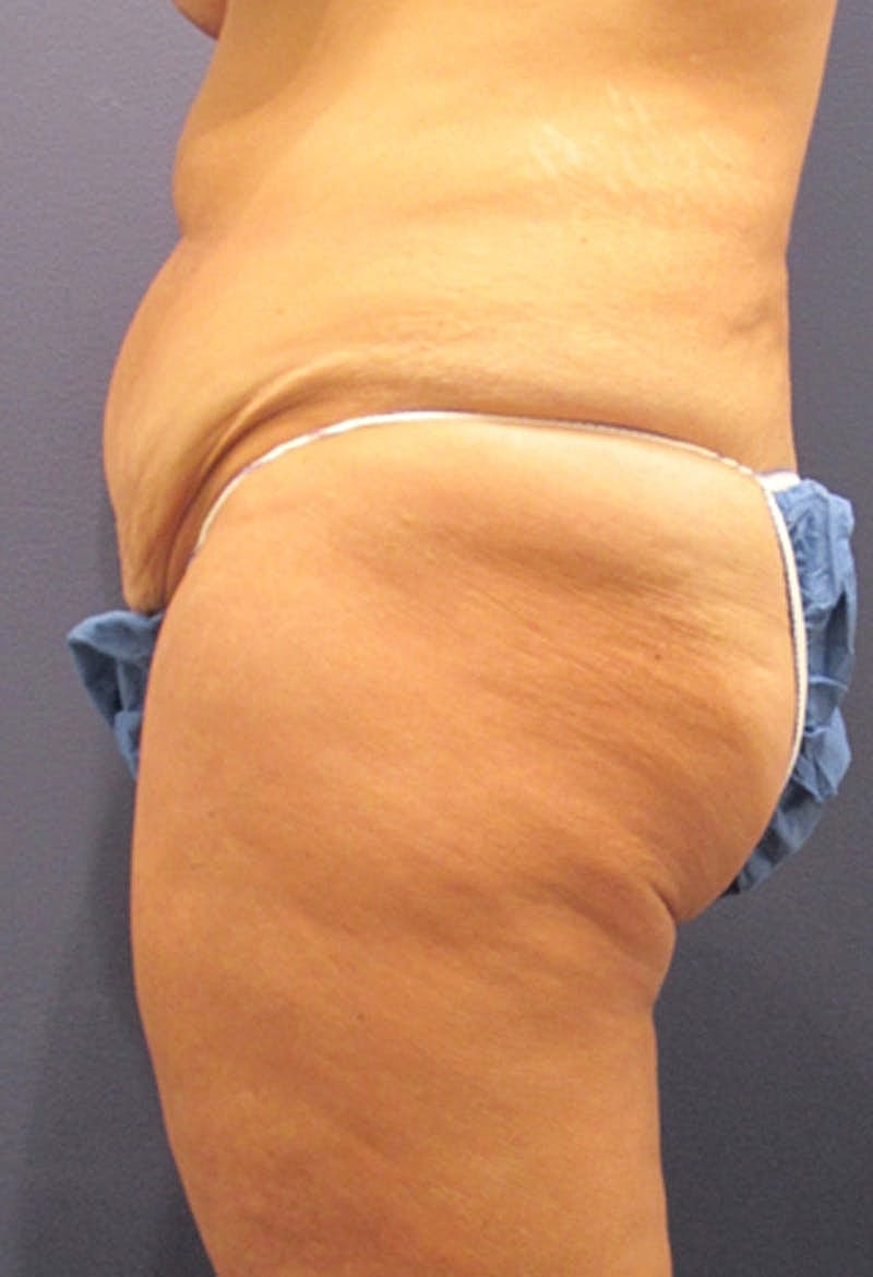 Tummy Tuck Before & After