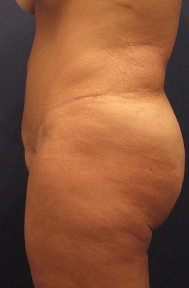 Tummy Tuck Before & After