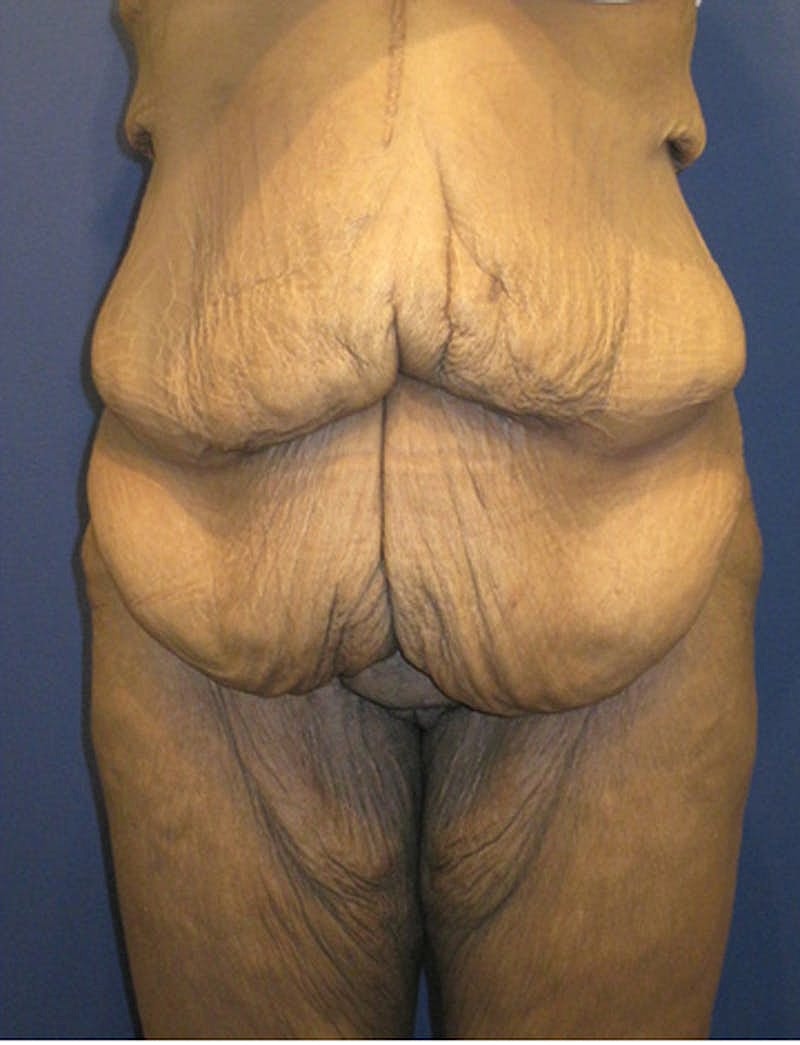 Tummy Tuck Before & After