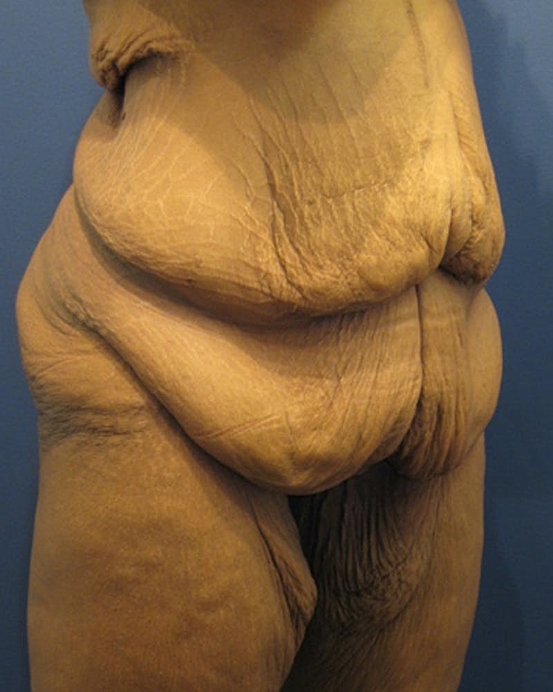 Tummy Tuck Before & After