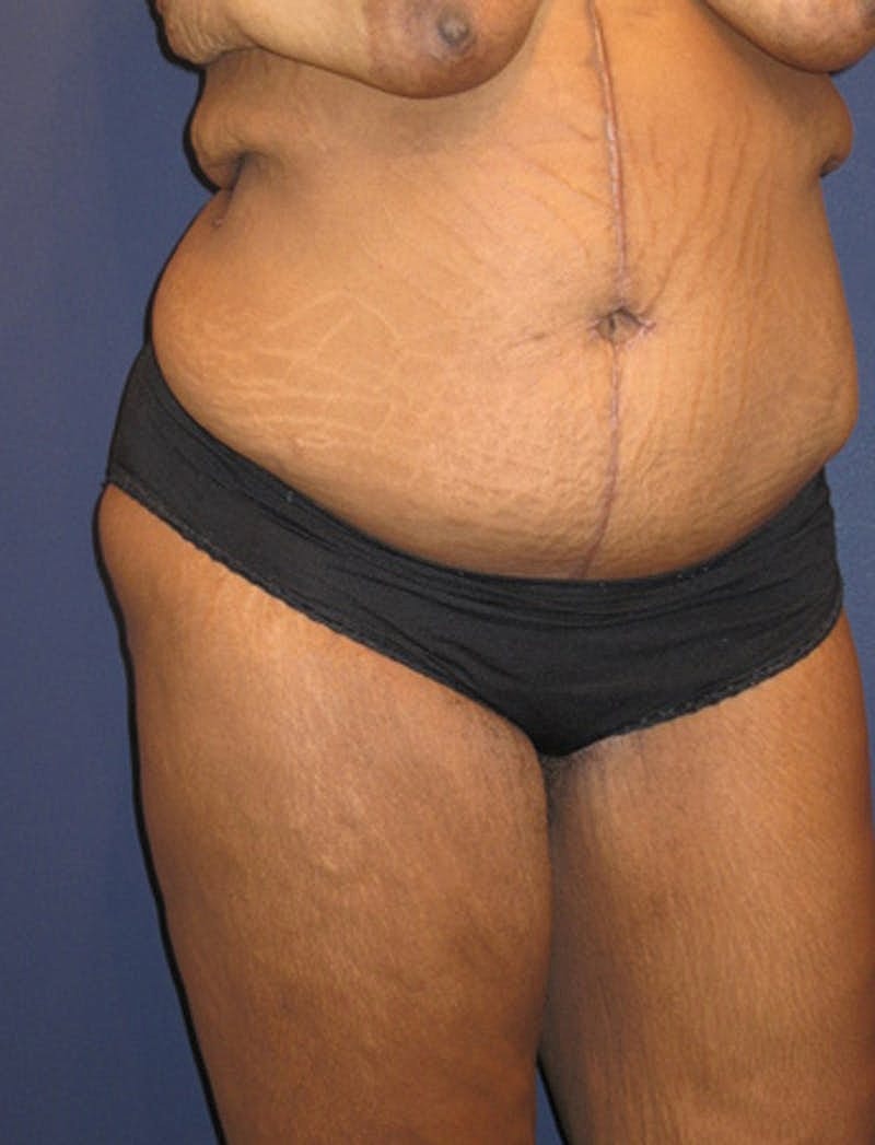Tummy Tuck Before & After
