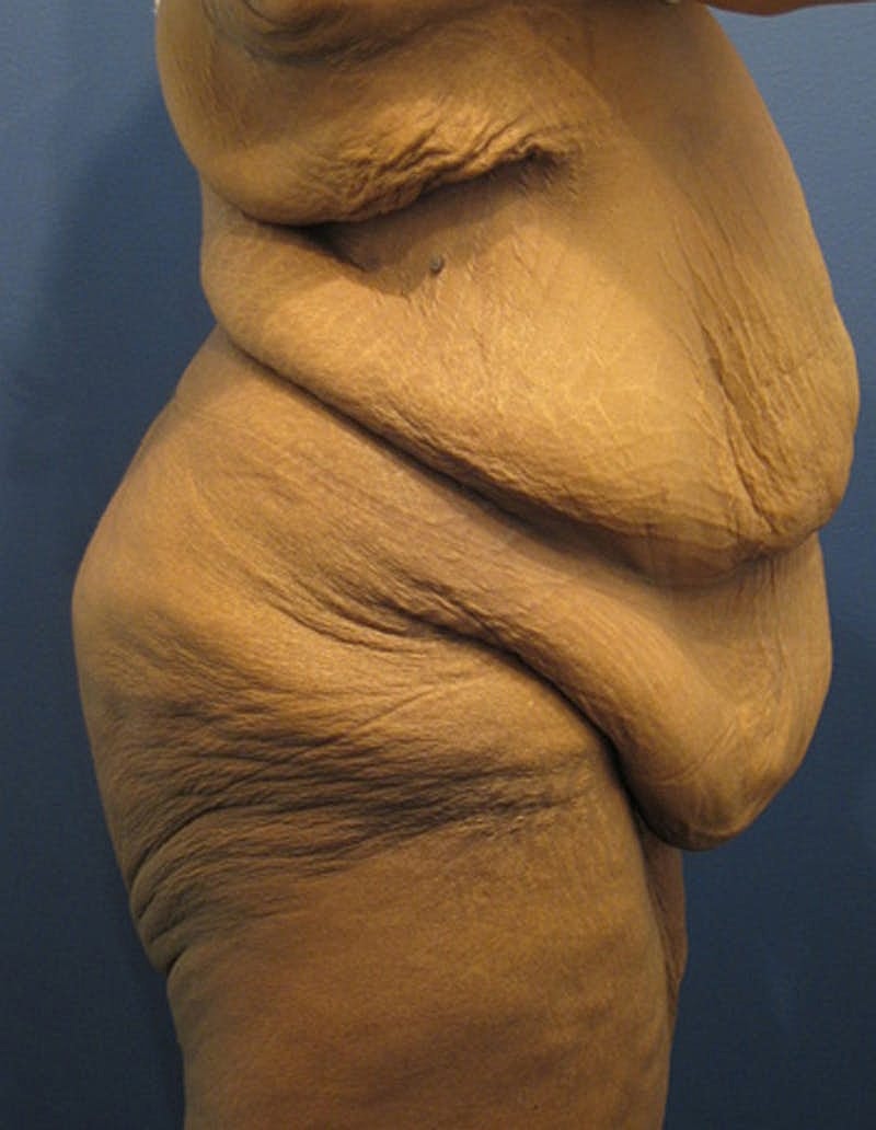 Tummy Tuck Before & After