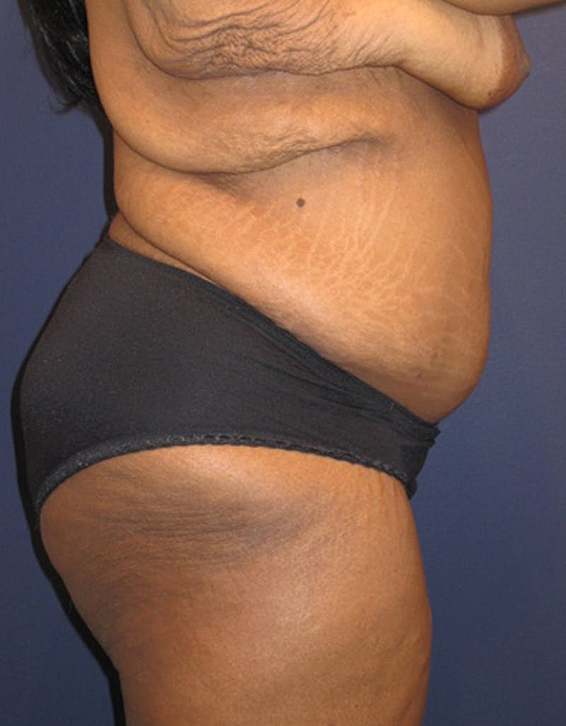 Tummy Tuck Before & After